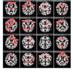 Ressonância magnética - pesquisa IA e Alzheimer 3