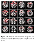 Ressonância magnética - pesquisa IA e Alzheimer 1