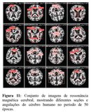 Ressonância magnética - pesquisa IA e Alzheimer 2