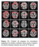 Ressonância magnética - pesquisa IA e Alzheimer 3
