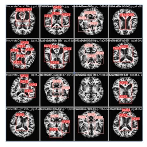 Alzheimer